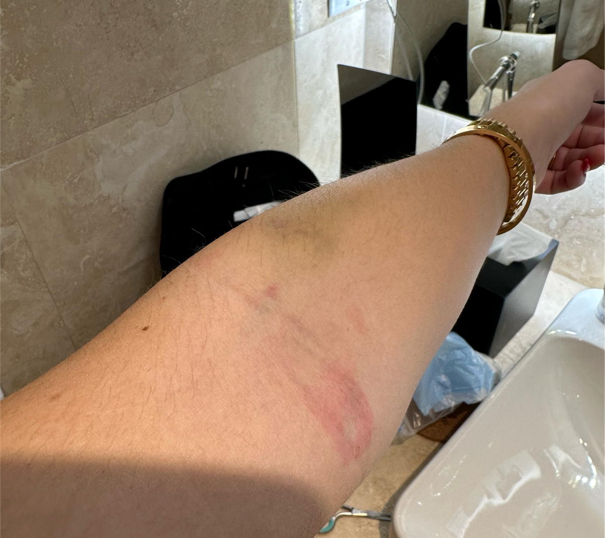 Bruise
